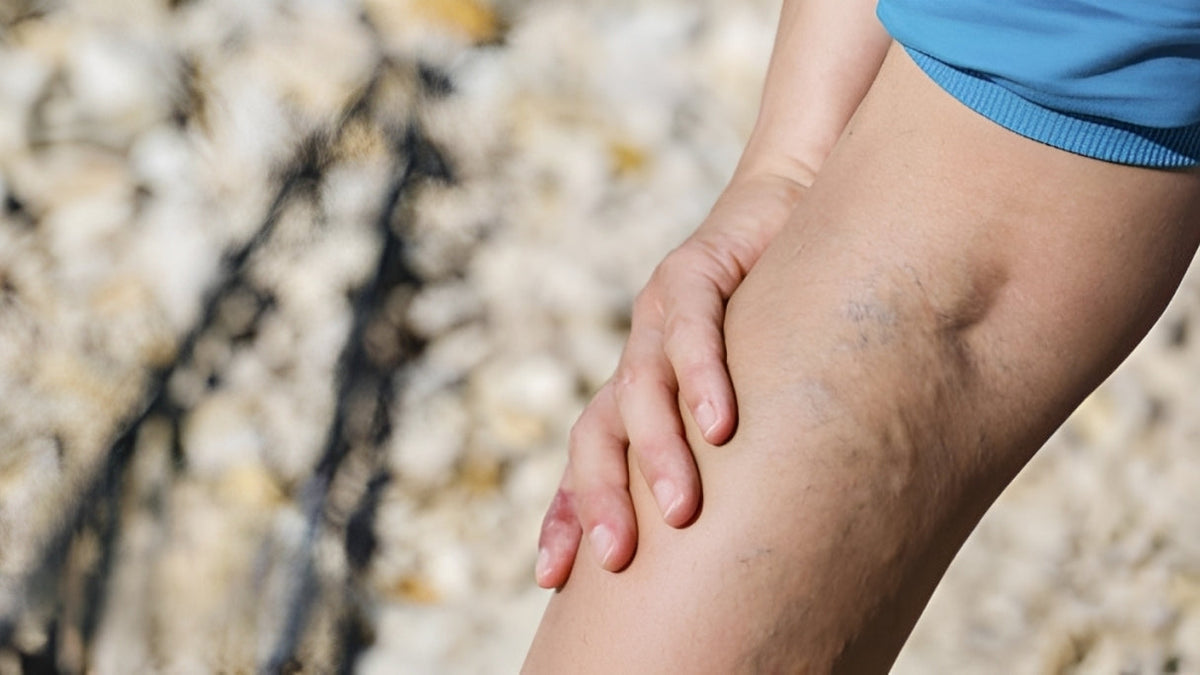 varices-mala-circulacion-piernas-invierno