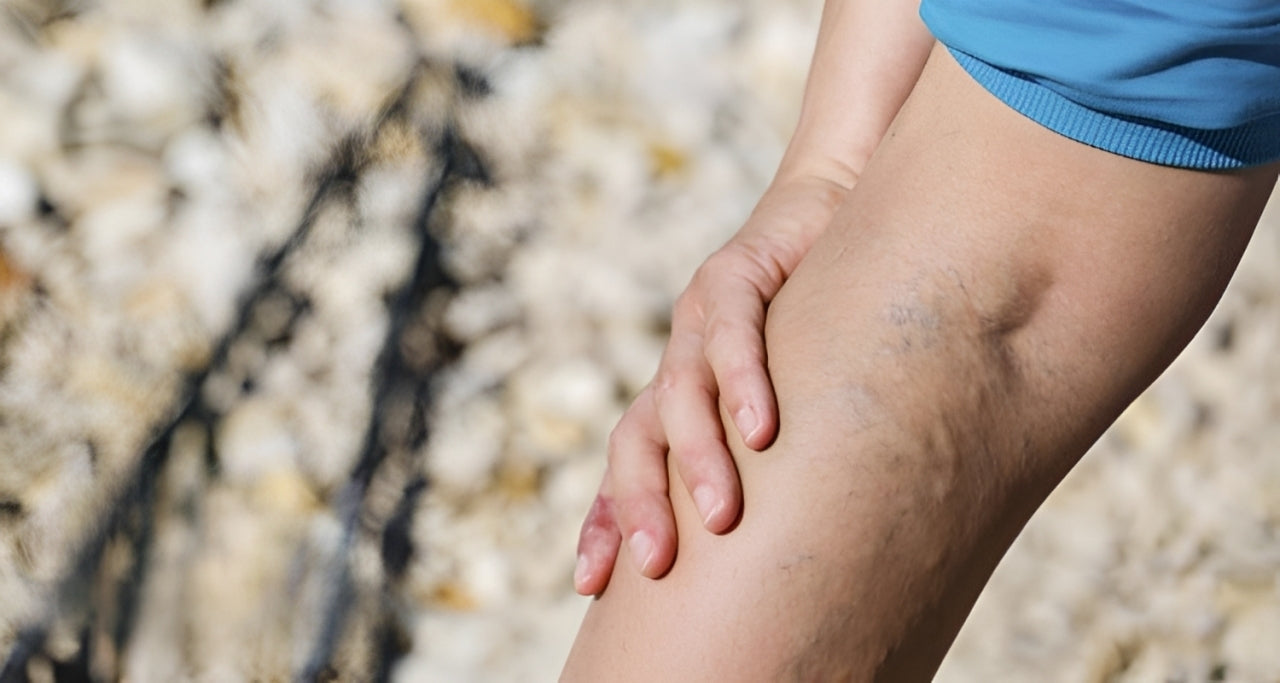 varices-mala-circulacion-piernas-invierno